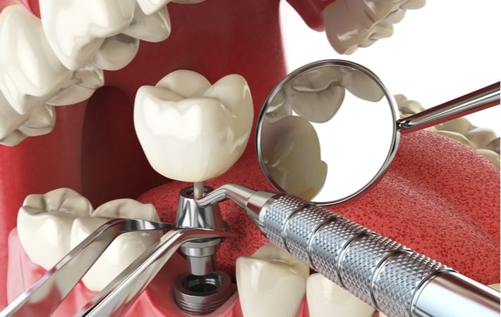 Dental Implants at Highland Woods Dentistry