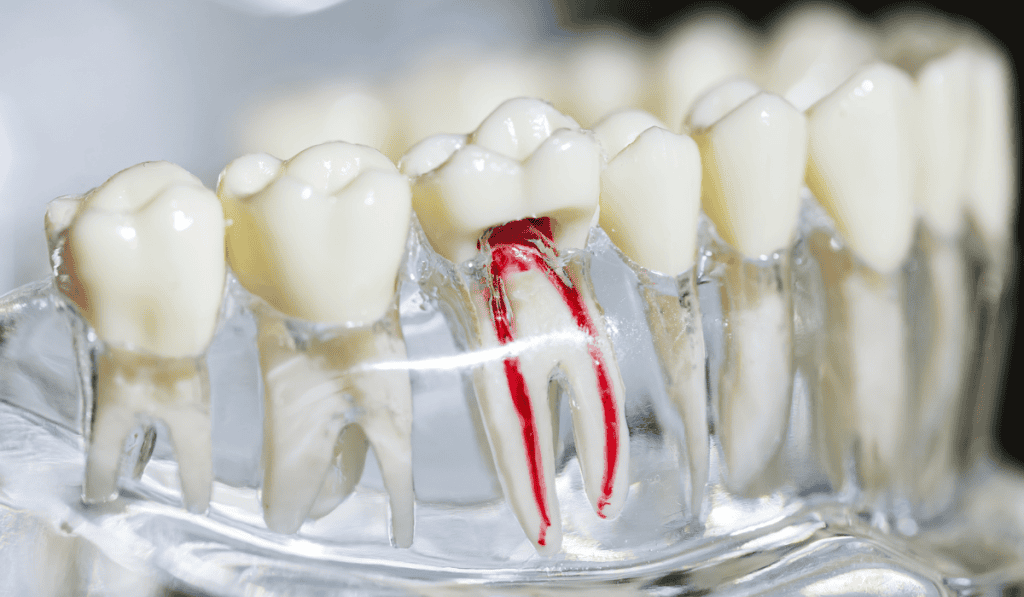 Root canals and extractions modern technology Highland Woods Dentistry